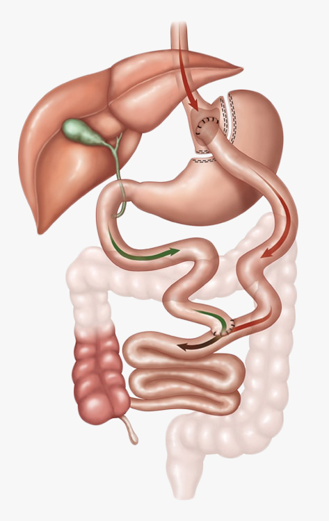 chirurgie bypass gastrique tunisie