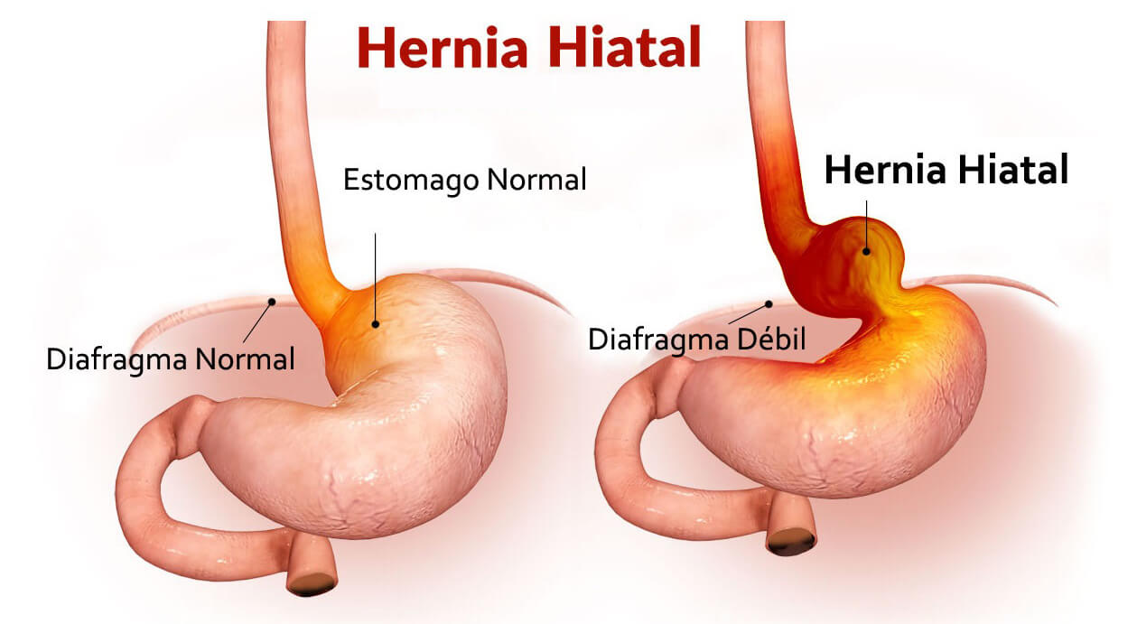Hernie Hiatale : Traitement chirurgical
